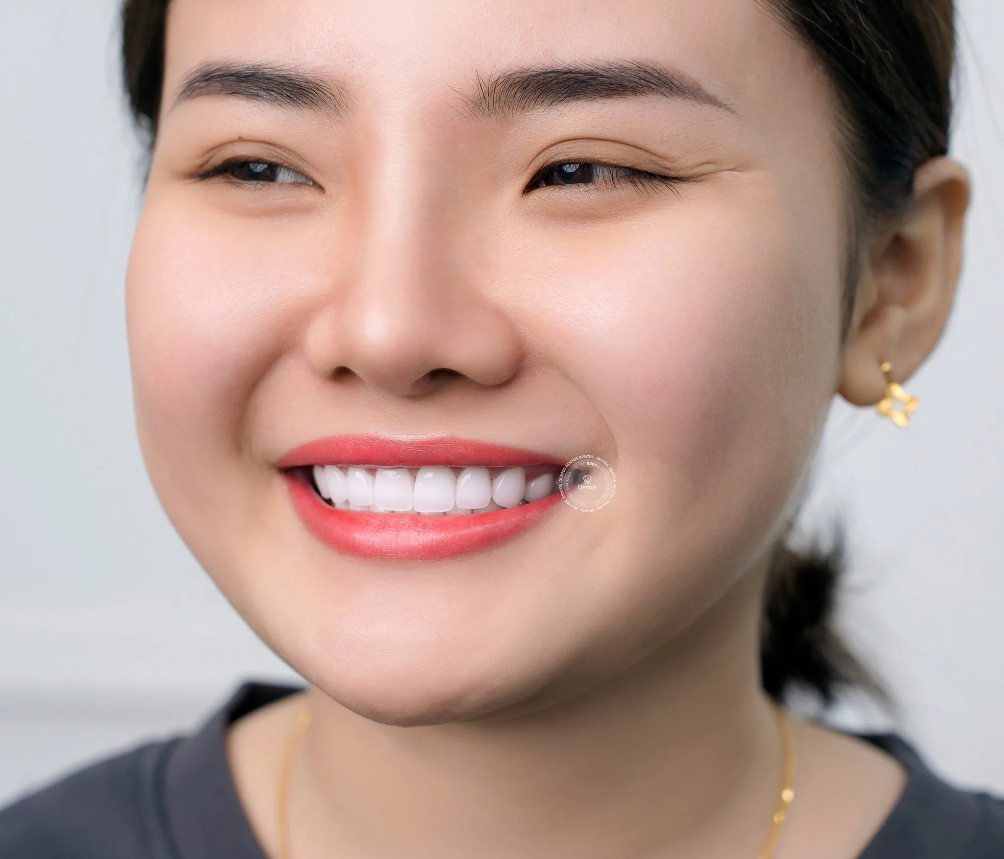 Zirconia là dòng răng sứ không kim loại có nguồn gốc từ Đức